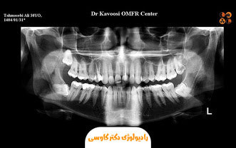 رادیوگرافی پانورکس (OPG) در کیانپارس