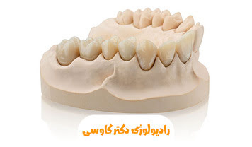 رزین کست دندانپزشکی در شهر اهواز | کاربردها، مزایا