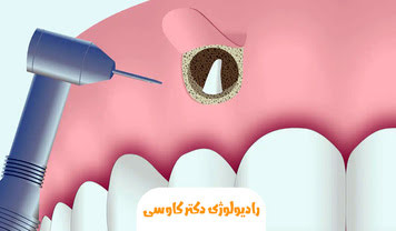 اپیکواکتومی یا جراحی ریشه دندان چیست؟