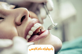 فورکیشن دندان چیست؟ بررسی کامل علل، علائم، درمان و پیشگیری