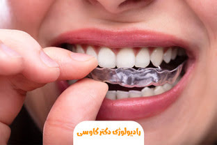 دندان قروچه در خواب چیست؟ | علائم، عوارض و درمان قطعی